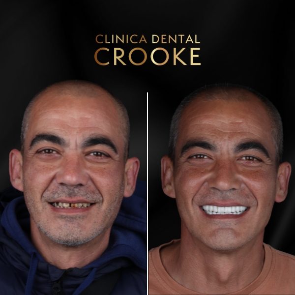 Antes y después del tratamiento, a la izquierda antes y a la derecha después: rehabilitación completa fija sobre implantes